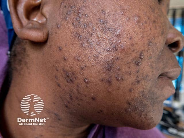 Post inflammatory pigmentation after facial acne in skin of colour