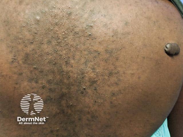 Hypertrophic scarring on the shoulder and post acne hyperpigmentation