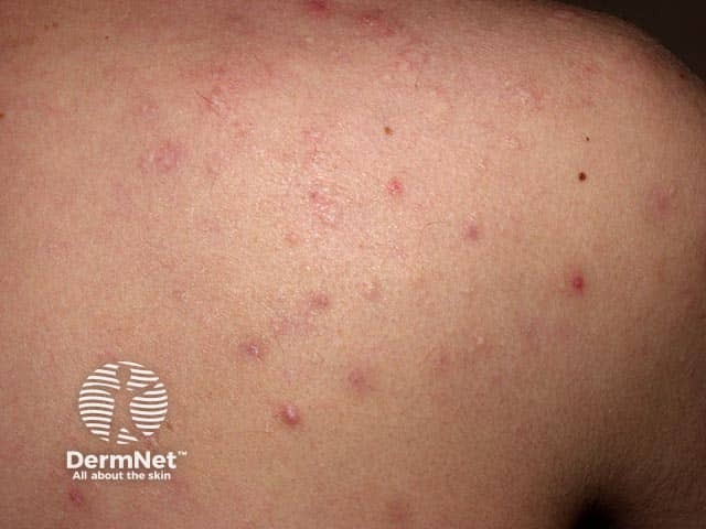 Active acne with perifollicular elastolysis and signs of old acne excoriation on the back