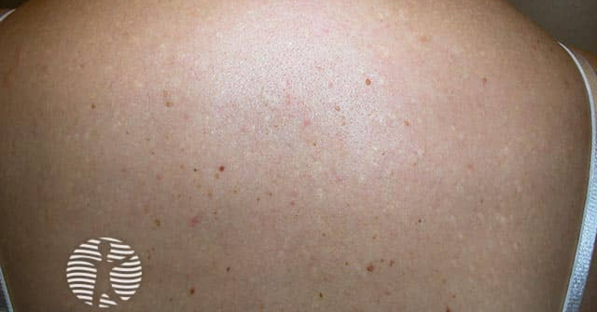 Acne scarring image