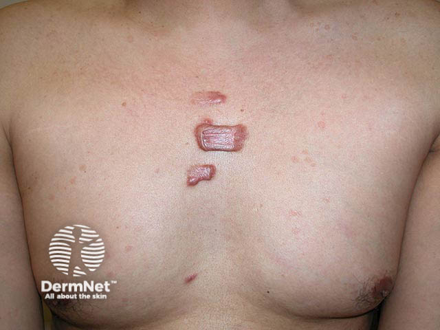 Bridged keloid scars from chest acne