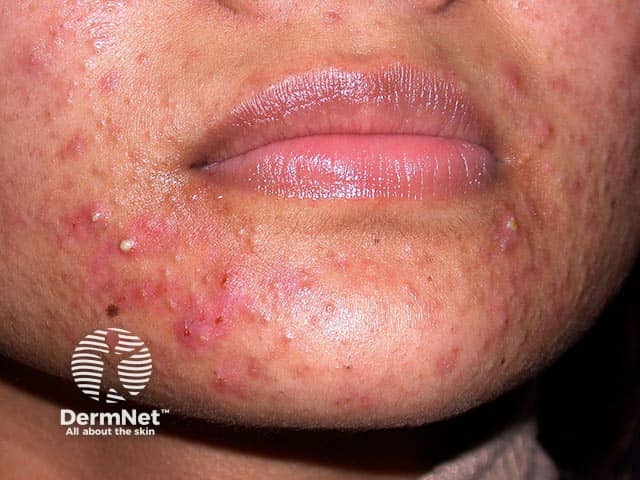 Mixed comedonal and inflammatory facial acne in skin of colour