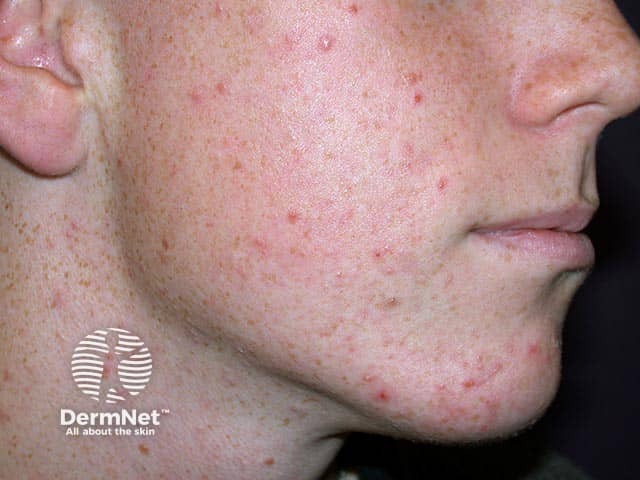 Clascoterone Uses Side Effects And More DermNet