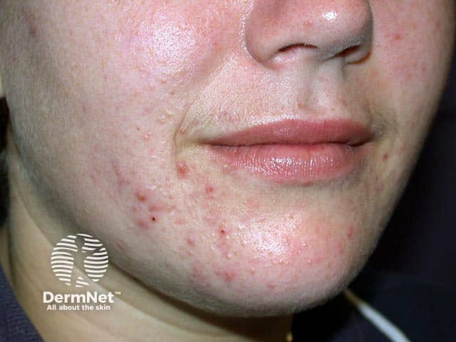 Papulopustular chin acne