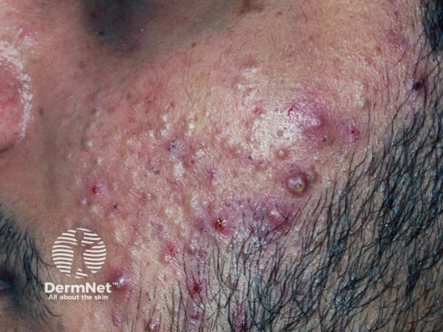 Comedones, papules, and pustules in acne