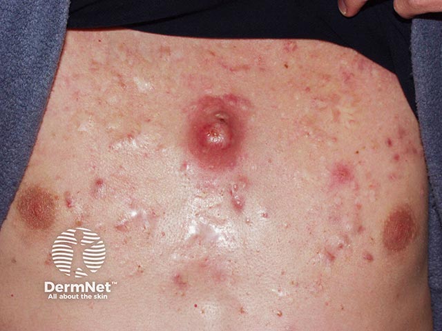 Chest acne with papules, pustules, scars, and a large acne cyst