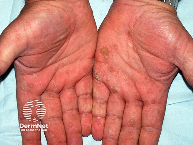 A hereditary punctate keratoderma