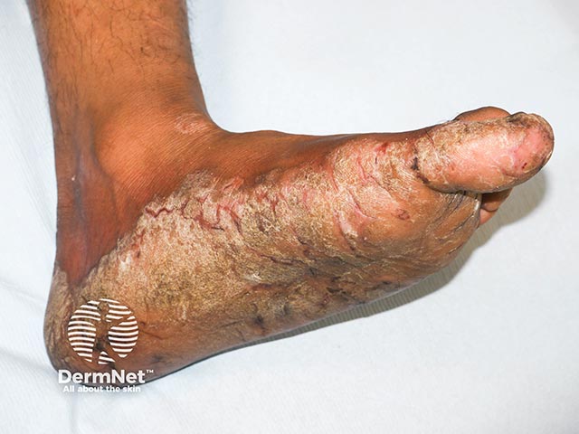 A gross acquired keratoderma due to palmoplantar plaque psoriasis