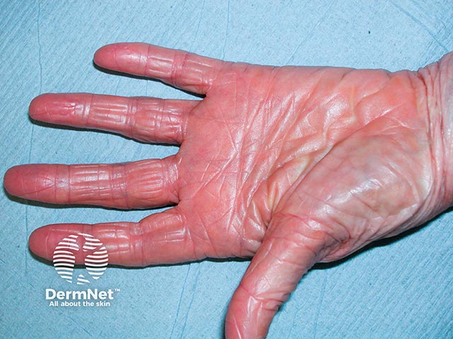 An orange-red waxy keratoderma in type 1 pityriasis rubra pilaris