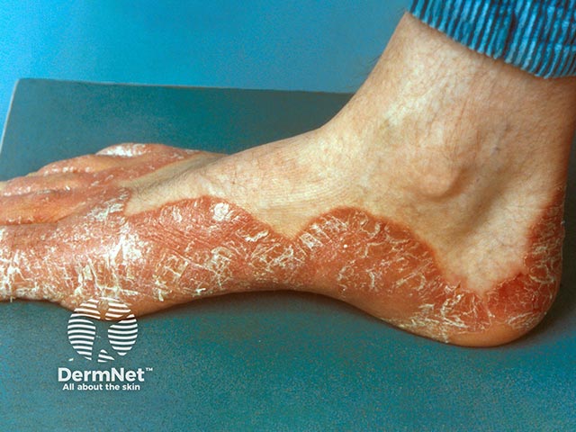 Plaque psoriasis of the sole producing an acquired keratoderma