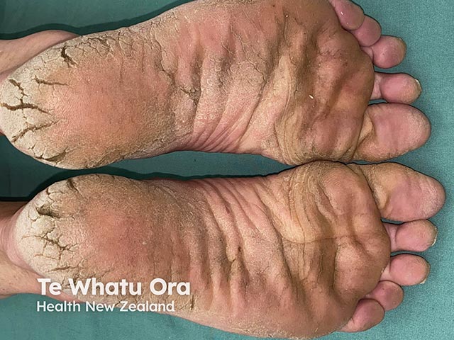 Symmetrical hyperkeratosis and gross heel fissuring in an acquired keratoderma