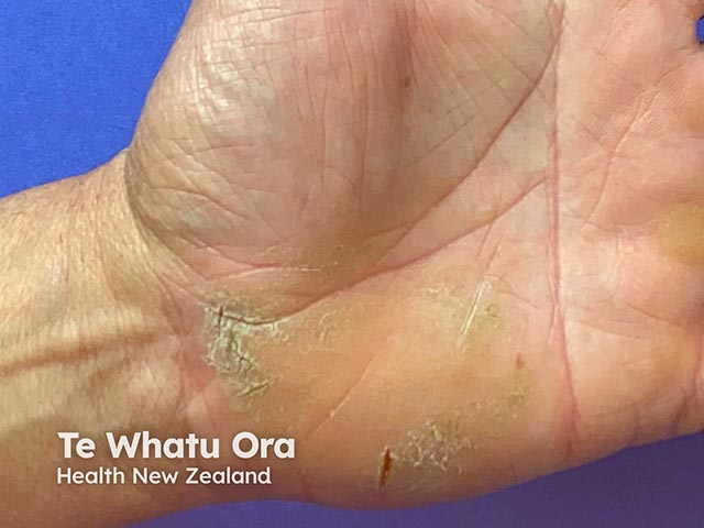 Hyperkeratosis and fissures on the palm in an acquired keratoderma