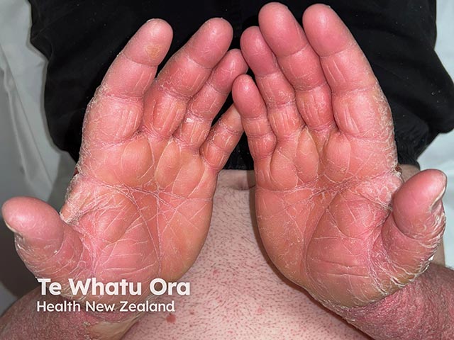 Diffuse hyperkeratosis and accentuation of skin creases on the palm in an acquired keratoderma