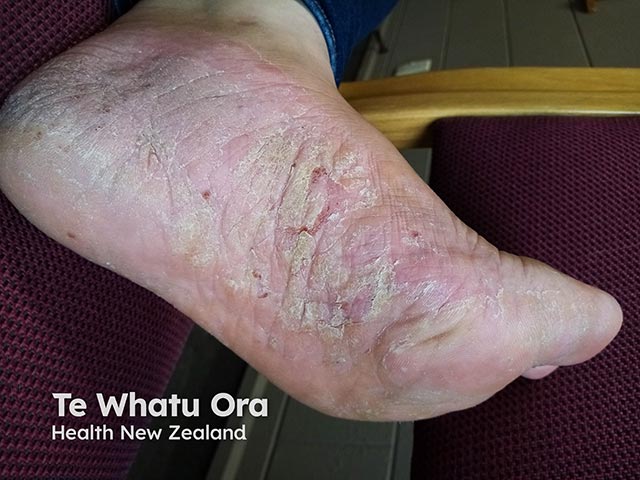 An acquired plantar keratoderma due to plaque psoriasis