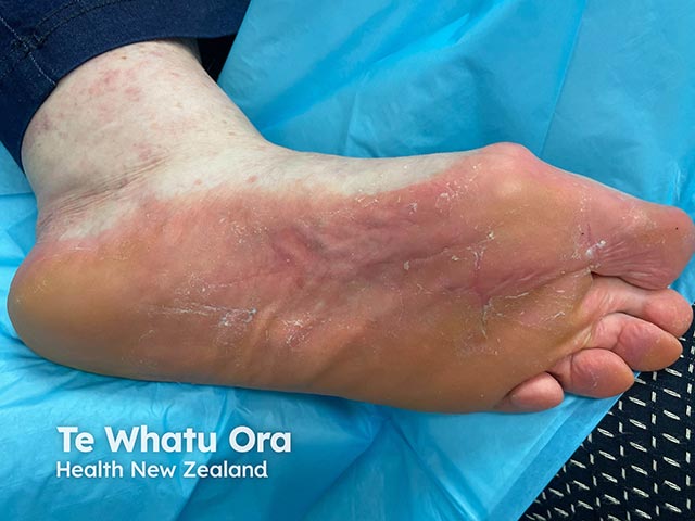 An acquired plantar keratoderma