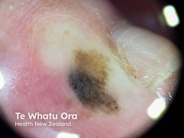 Dermoscopy of an acral melanoma in situ on the toe