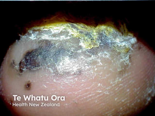 Irregular pigmentation of the hyponychium due to a subungual melanoma