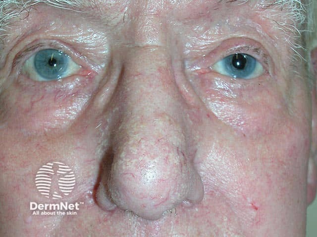Yellow lesions of solar elastosis on the nose