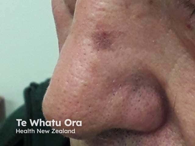 An actinic keratosis on the nose