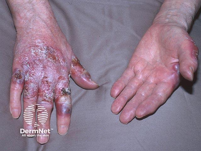 Haemorrhagic oedematous plaques, typical of acute febrile neutrophilic dermatosis of the dorsal hands