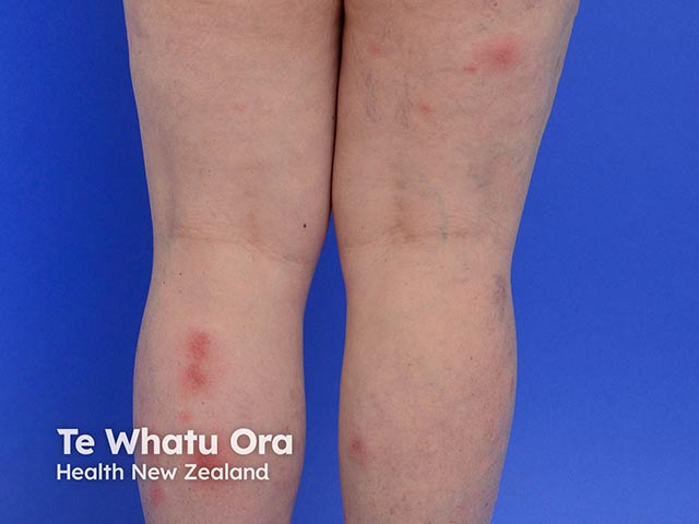 Acute febrile neutrophilic dermatosis on the legs