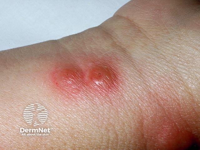 Acute febrile neutrophilic dermatosis on the wrist