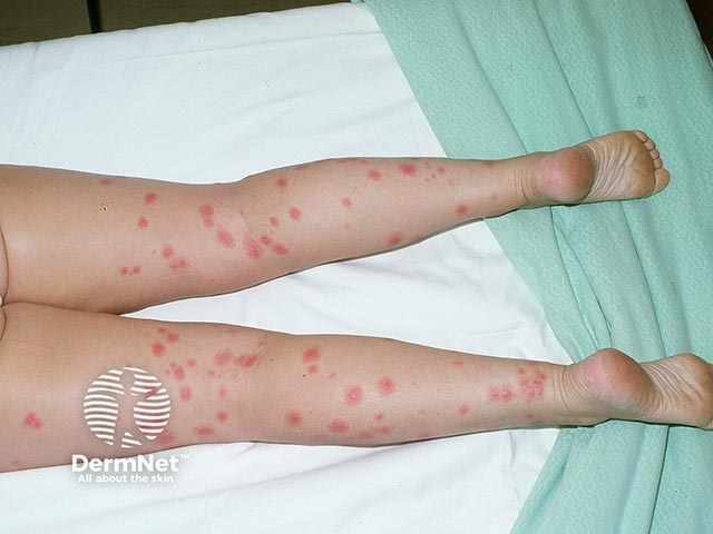 Extensive acute febrile neutrophilic dermatosis on the legs