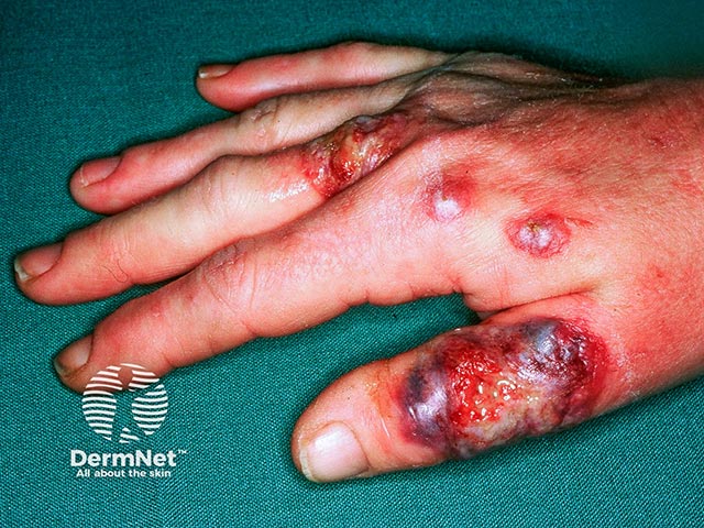 Acute febrile neutrophilic dermatosis of the dorsal hands