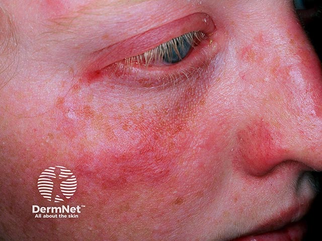 Acute febrile neutrophilic dermatosis causing oedematous plaques on the cheek - note there is also a red eye