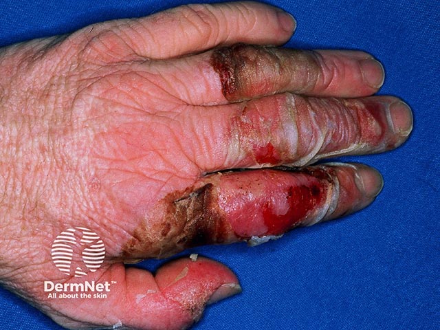 Acute febrile neutrophilic dermatosis of the dorsal hands