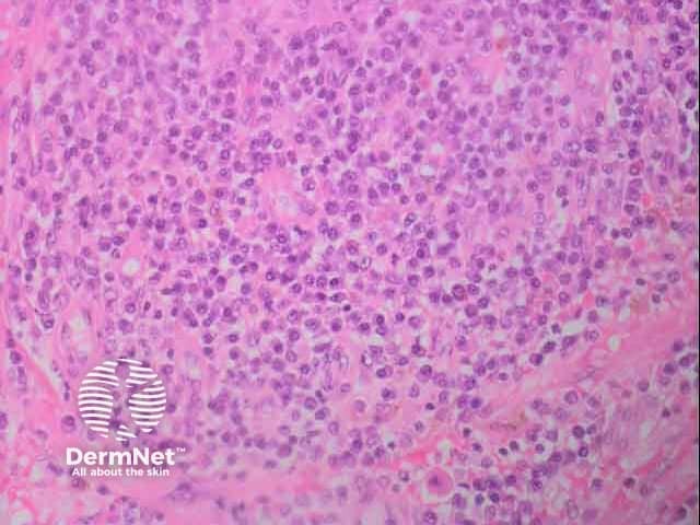 Cutaneous myleoid sarcoma H and E histology