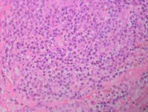 Acute myeloid leukaemia