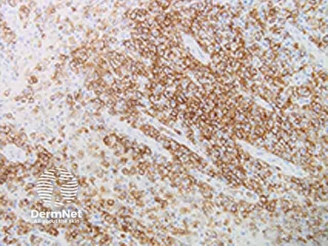 Cutaneous myeloid sarcoma CD 68 immunohistochemistry