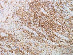 Acute myeloid leukaemia