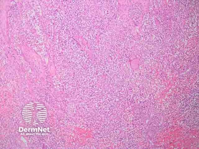 Cutaneous myeloid sarcoma H and E histopathology