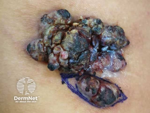 Warty cutaneous myeloid sarcoma on thigh