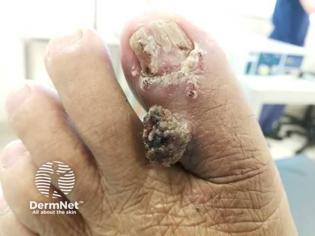 Cutaneous myeloid sarcoma on the great toe