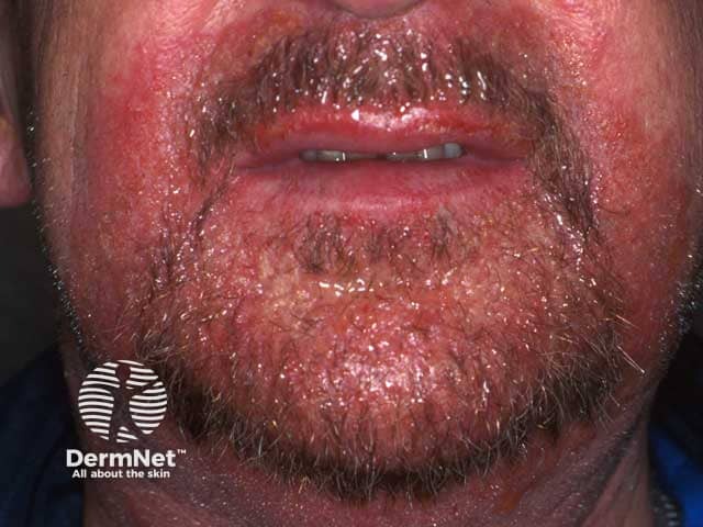 Acute weepy facial eczema due to beard dye allergy