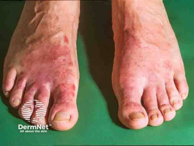 Symmetrical eczema on the dorsal feet, sparing the interdigital spaces, due to chromate allergy