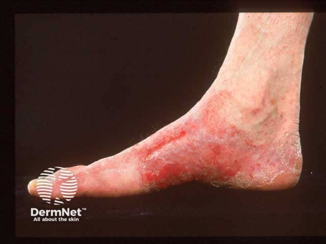Allergic contact dermatitis of the foot due to PTBP resin in a shoe adhesive