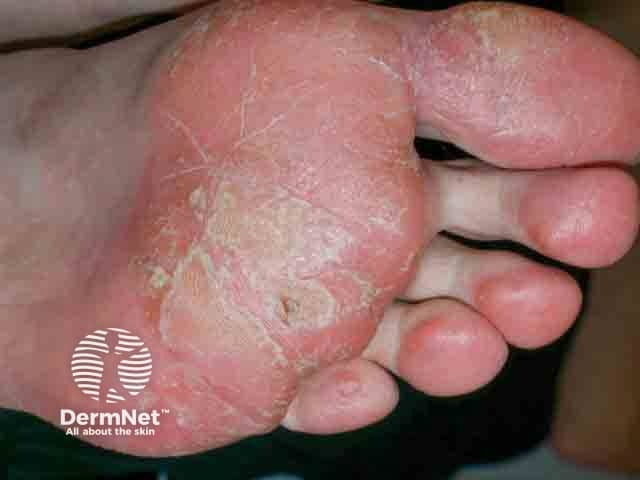 Allergic contact dermatitis on the sole due to PTBP resin