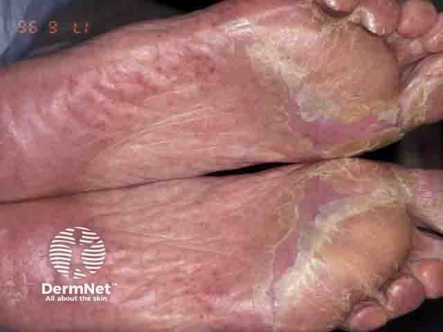 Symmetrical plantar contact dermatitis due to a rubber accelerator in the shoe sole