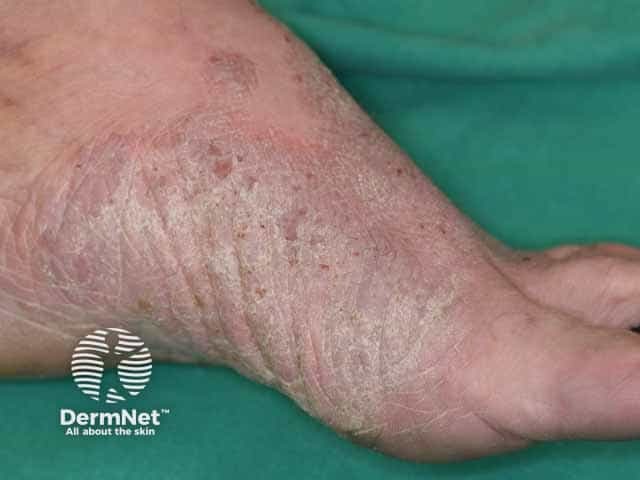 Allergic contact dermatitis due to a shoe upper component