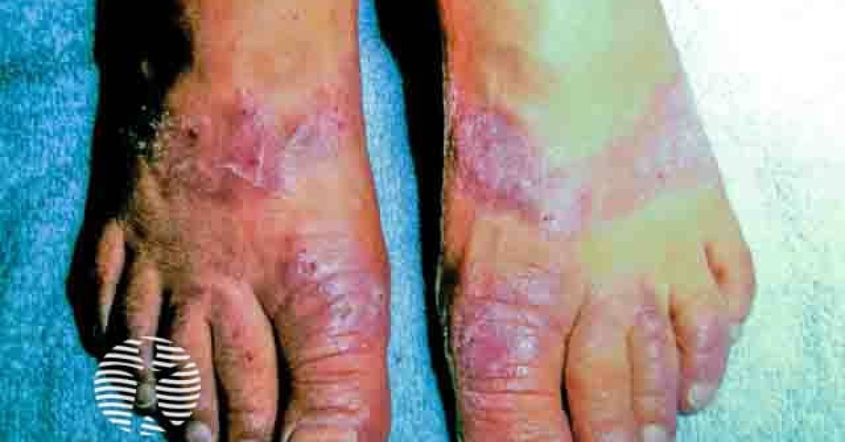 Allergic contact dermatitis image