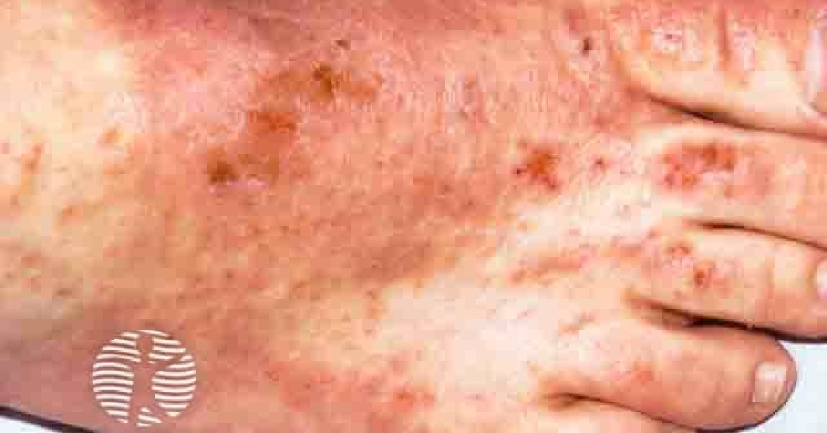 Allergic contact dermatitis image