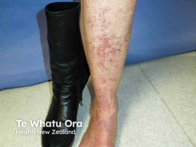 Allergic contact dermatitis due to a leather boot - chromate allergy was confimed on patch testing