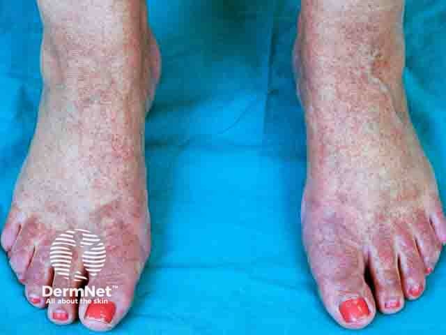 Allergic contact dermatitis over the forefoot