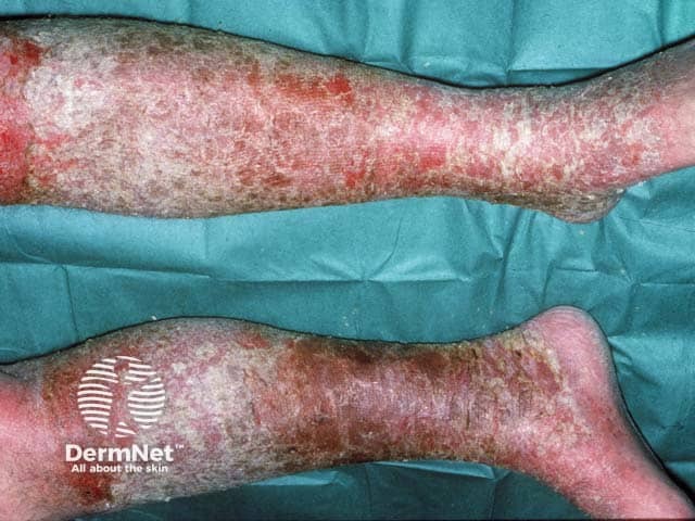 Gravitational eczema compounded by a contact allergy to a bandage constituent