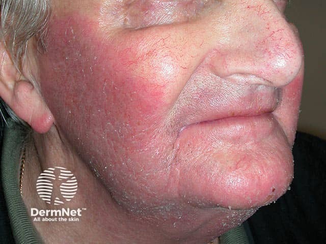 Facial contact dermatitis caused by fragrance in wife’s hair spray