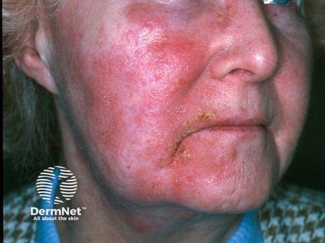 Facial contact dermatitis due to allergy to partner’s aftershave